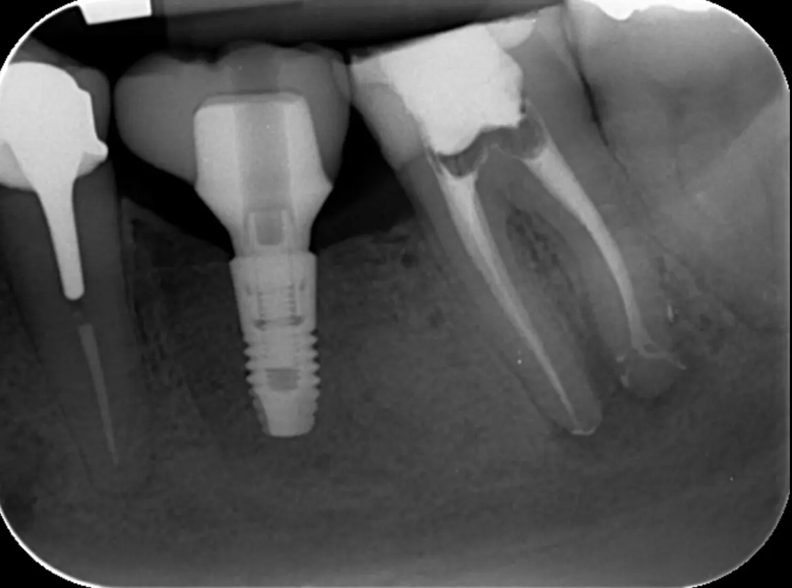 Endodontie de première intention - Formation e-learning